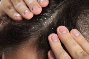 Зимна грижа за скалпа: как да предотвратим пърхот, сухота и лющене